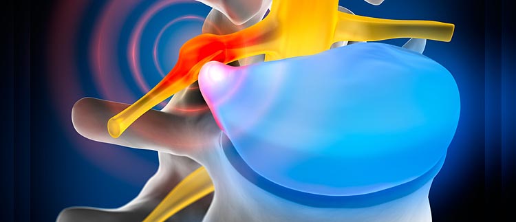 Bandscheibenvorfälle