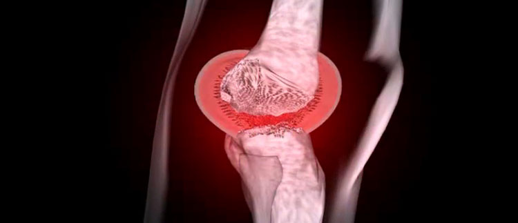 Erkrankungen des rheumatischen Formenkreises