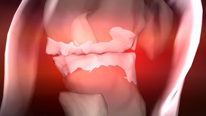 Informationsvideo zum Thema 'Arthrose'