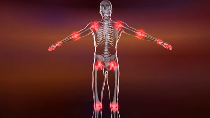 Informationsvideo zum Thema 'Rheuma'